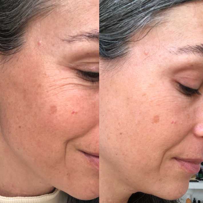 a side by side shot of before and 30 days after a woman used Maya Chia straight A retinol treatment