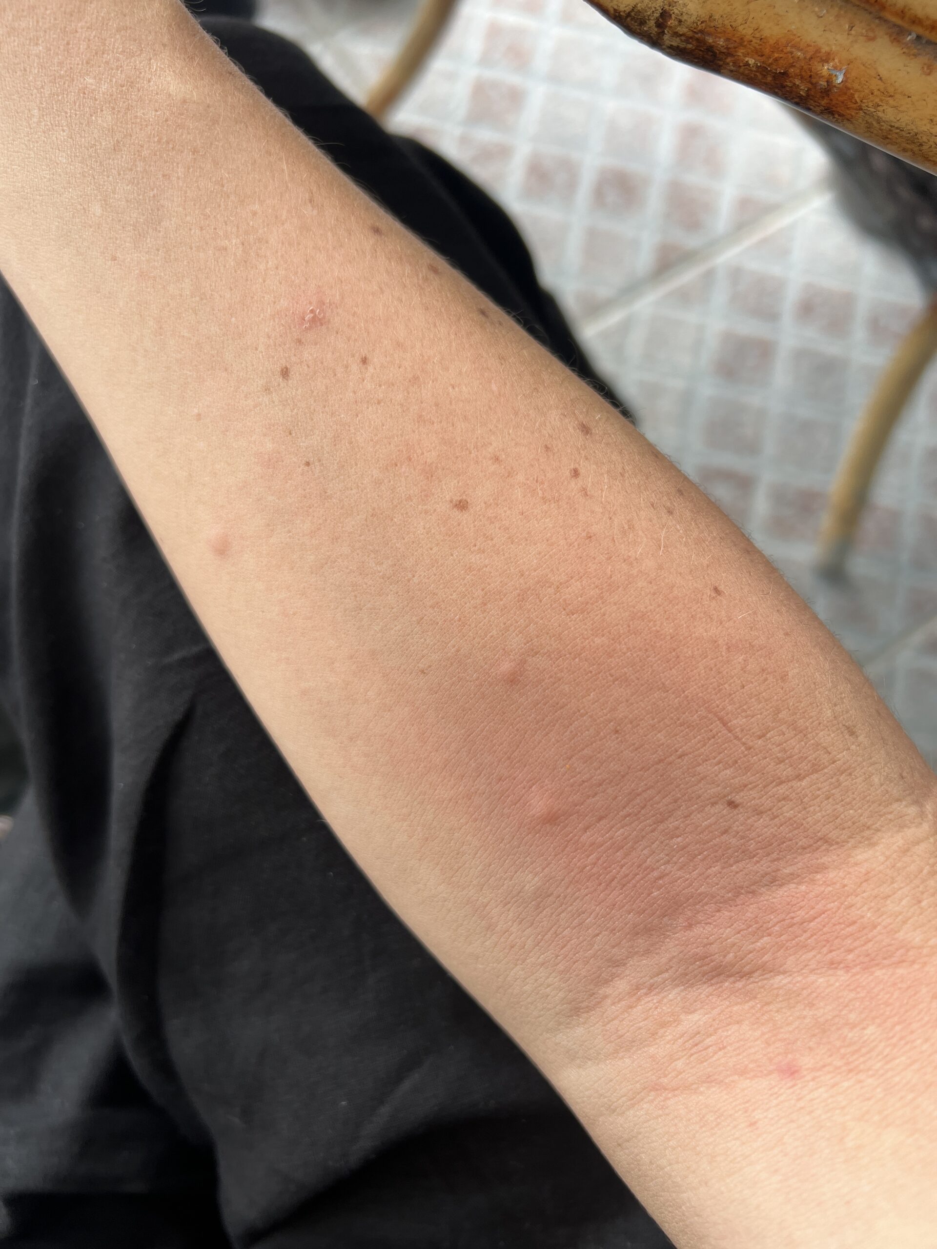 A close up of a woman's arm from bug bites.